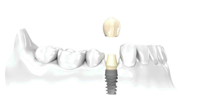 Implante para apenas um dente em falta na PERFECT SMILE